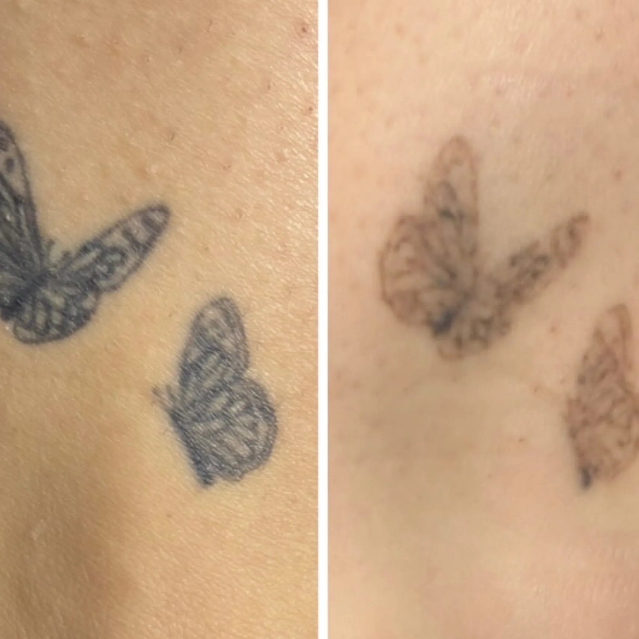 dark patches post tattoo healing