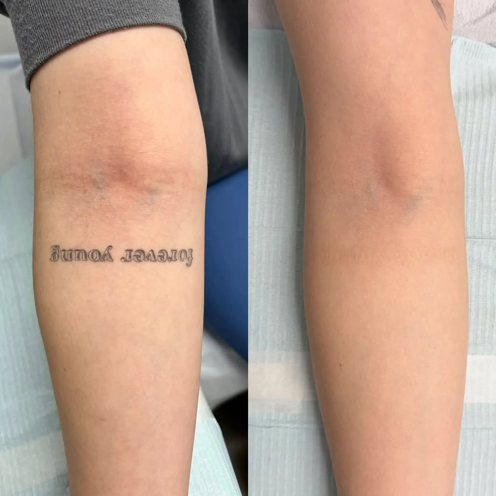 skin inflammation after tattoo session